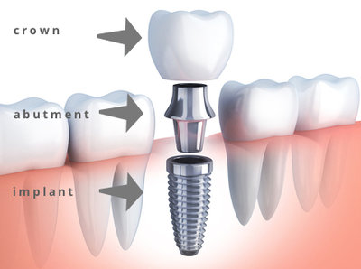 dental-implant-parts.jpg